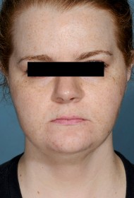 Liposuction before and after - before