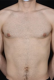 Breast Reduction before and after - after