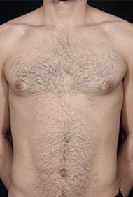 Breast Reduction before and after - before