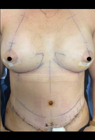 Breast Augmentation before and after - after