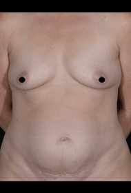 Breast Augmentation before and after - before