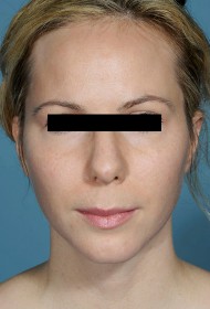 Liposuction before and after - after
