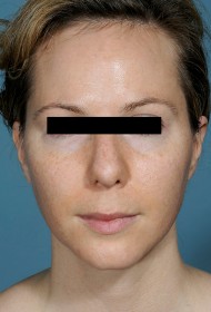Liposuction before and after - before