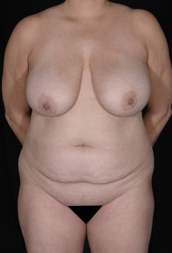 Mommy Makeover before and after - before