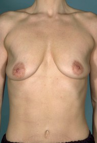 Procedure before and after - before