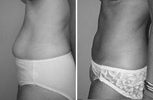 Arm Liposuction before and after - after