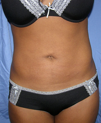 Liposuction before and after - after