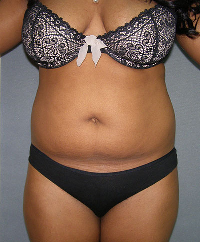 Liposuction before and after - before