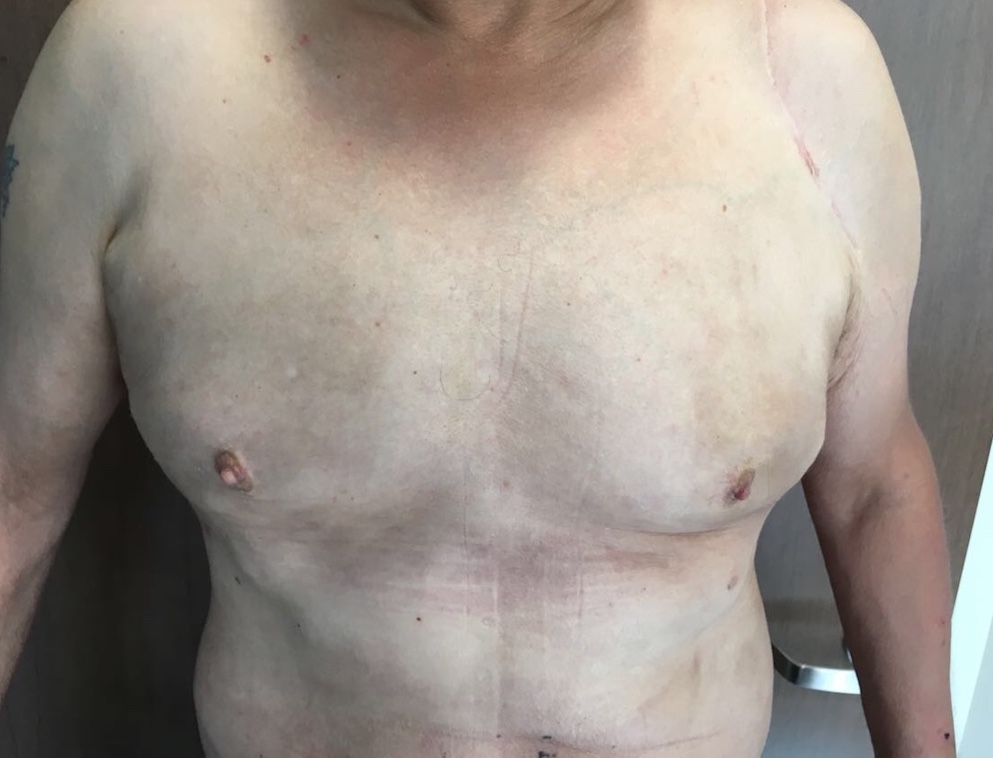 Liposuction before and after - after