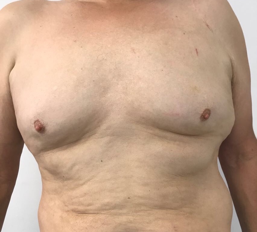 Liposuction before and after - before