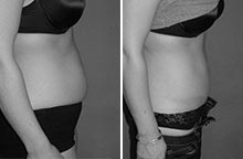 Arm Liposuction before and after - after
