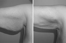 Arm Liposuction before and after - before