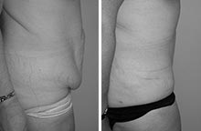 Arm Liposuction before and after - after