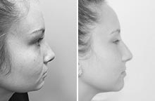 Arm Liposuction before and after - before