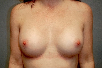 Breast Augmentation before and after - after