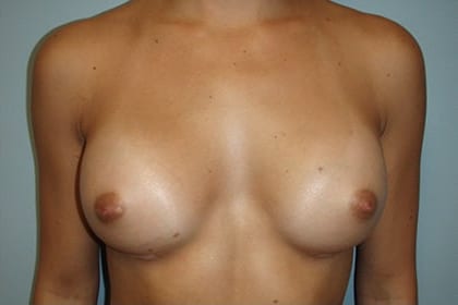 Breast Augmentation before and after - after