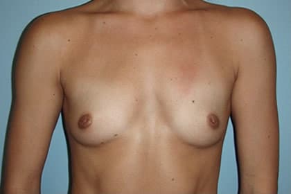Breast Augmentation before and after - before