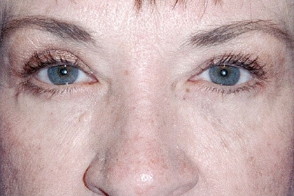 Blepharoplasty before and after - after