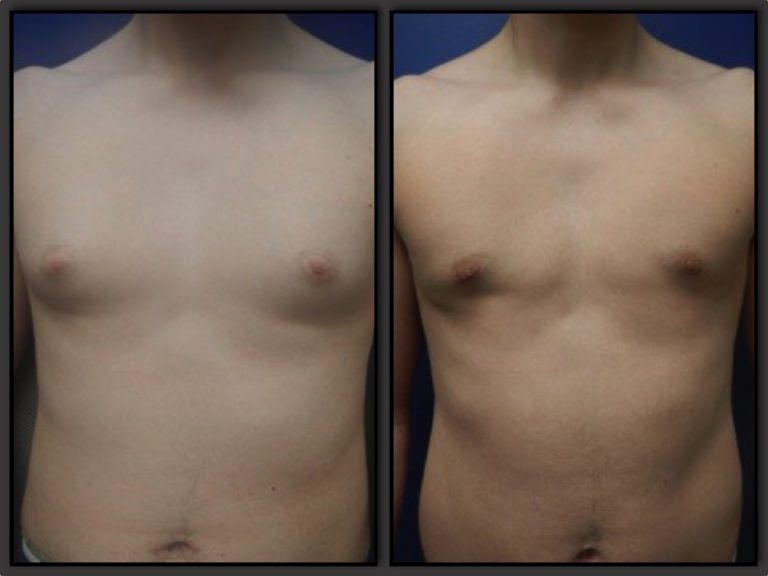 Male Breast Reduction before and after - after