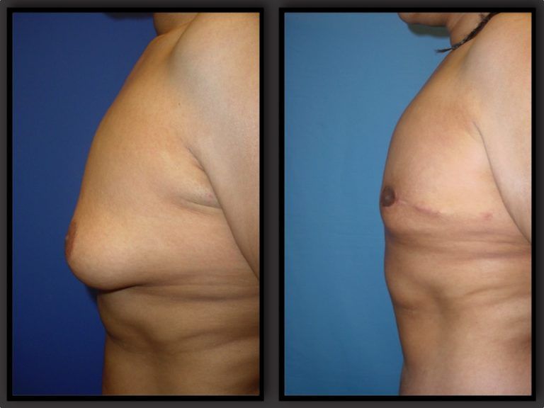 Male Breast Reduction before and after - before