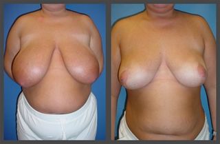Breast Reduction before and after - after