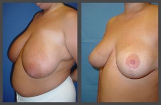 Breast Reduction before and after - before