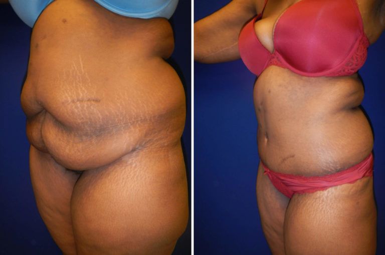 Tummy Tuck before and after - after