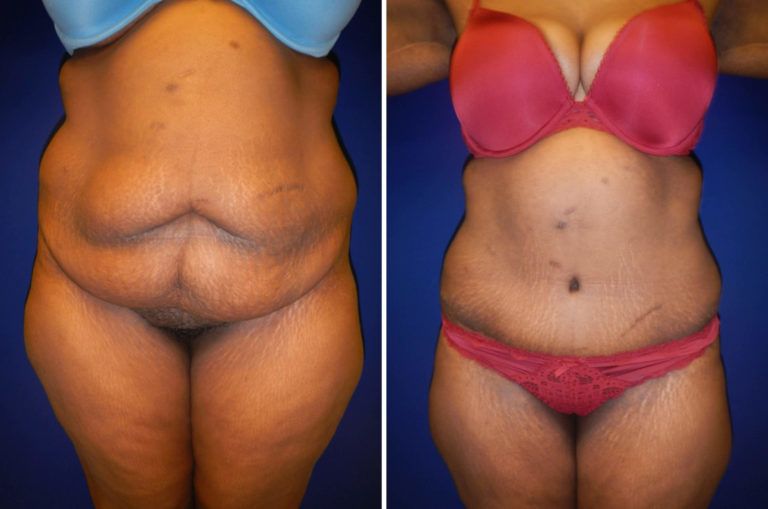 Tummy Tuck before and after - before