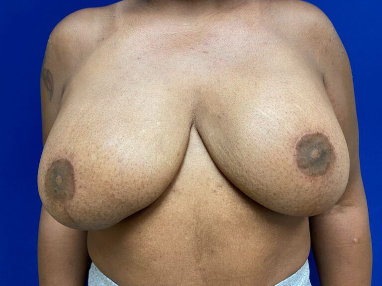 Nipple Tattooing before and after - before