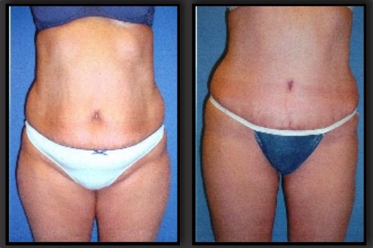 Tummy Tuck before and after - before