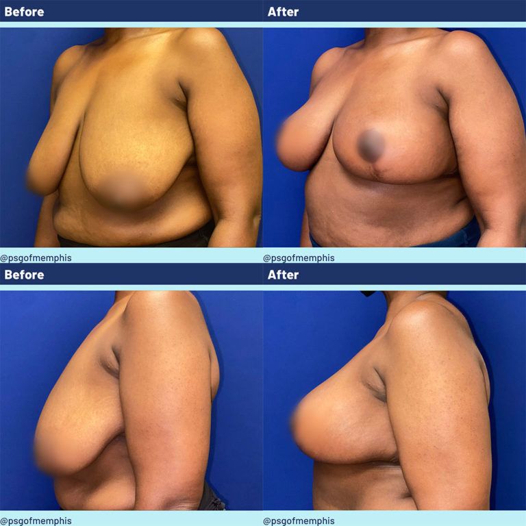 Breast Lift before and after - after