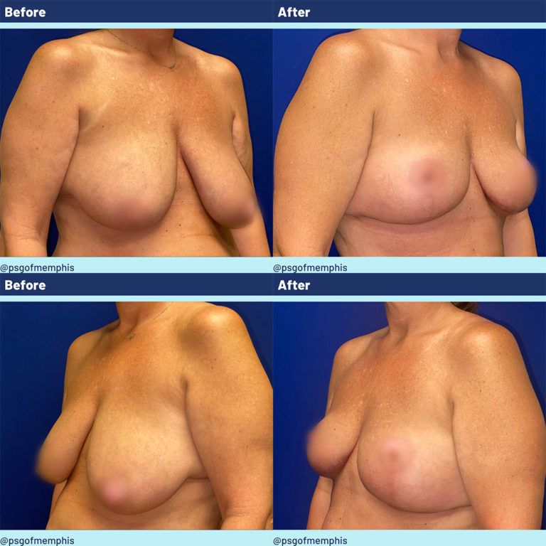 Breast Lift before and after - before