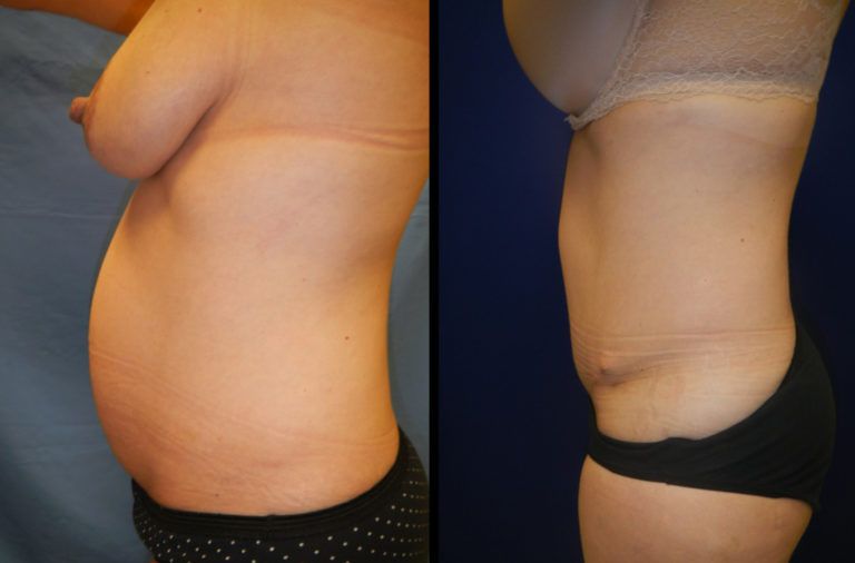 Mommy Makeover before and after - after