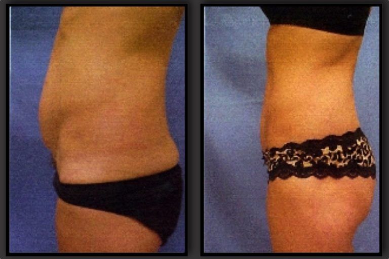 Tummy Tuck before and after - after