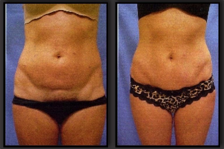 Tummy Tuck before and after - before