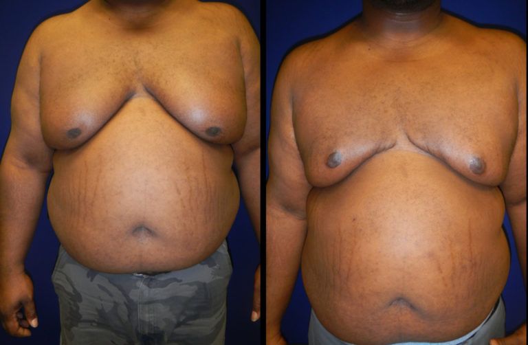 Male Breast Reduction before and after - after
