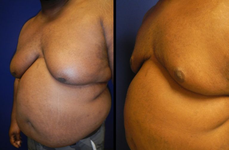 Male Breast Reduction before and after - before
