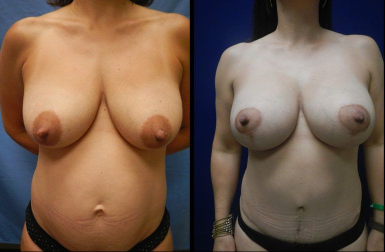 Mommy Makeover before and after - before
