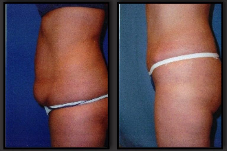 Tummy Tuck before and after - after