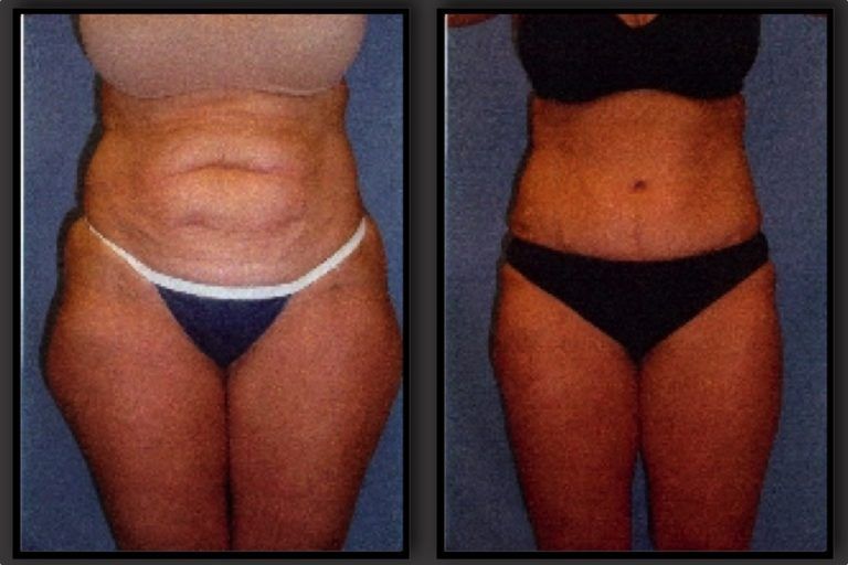Tummy Tuck before and after - before