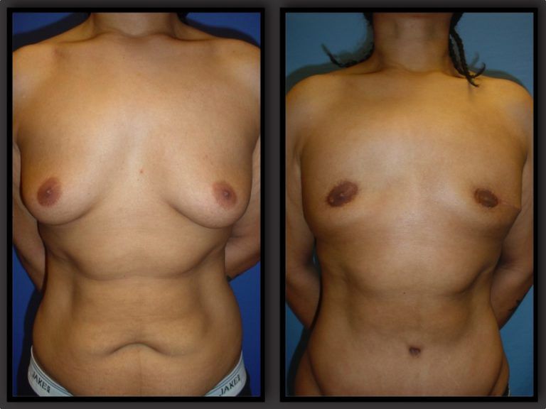Male Breast Reduction before and after - after