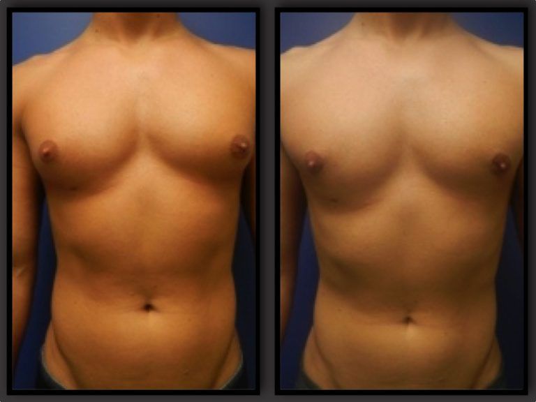Male Breast Reduction before and after - before