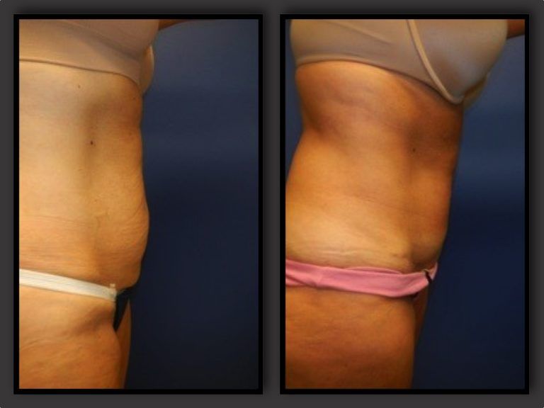 Mommy Makeover before and after - after