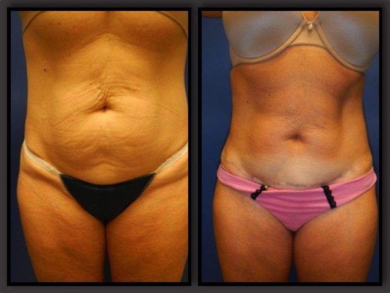 Mommy Makeover before and after - after