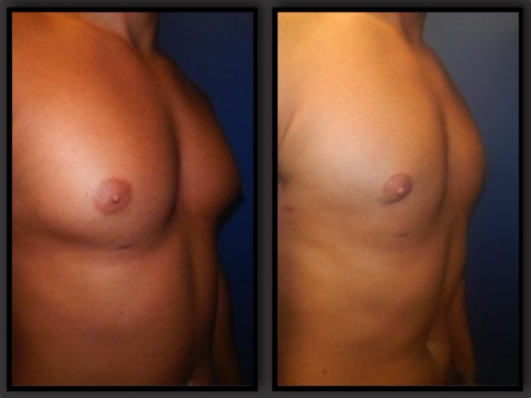 Male Breast Reduction before and after - after
