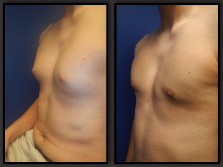 Male Breast Reduction before and after - before