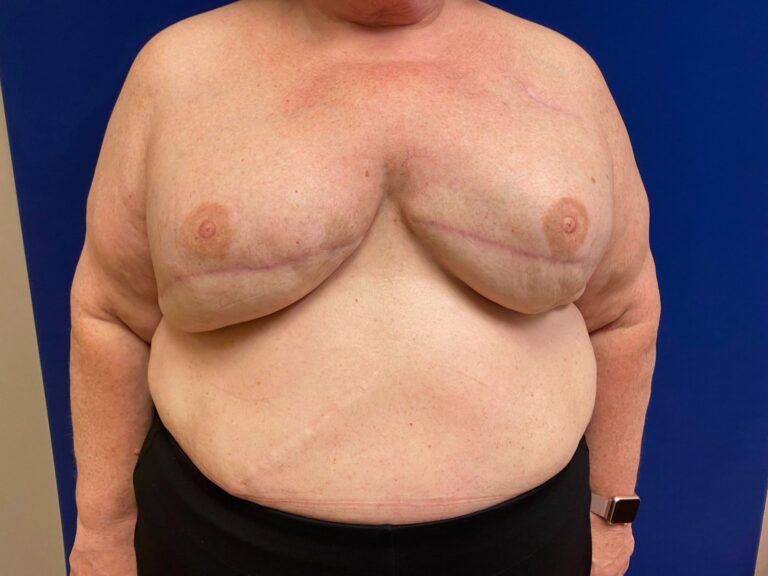 Nipple Tattooing before and after - before