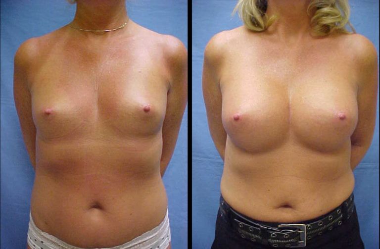 Breast Augmentation before and after - after
