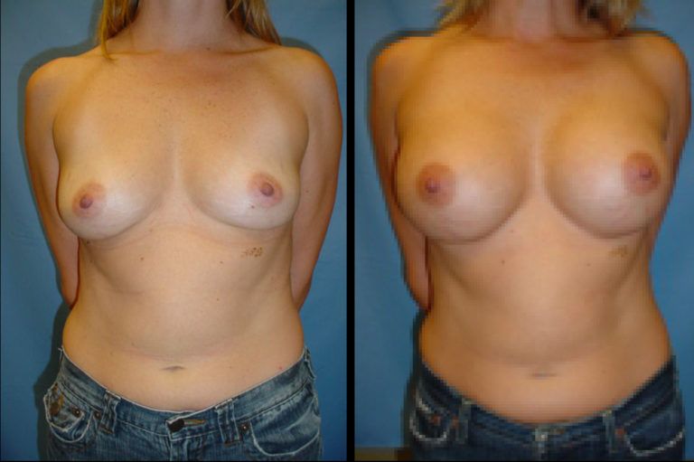 Breast Augmentation before and after - before