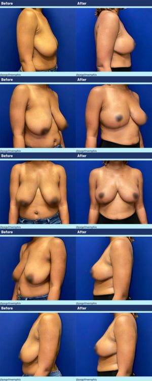 Breast Lift before and after - after